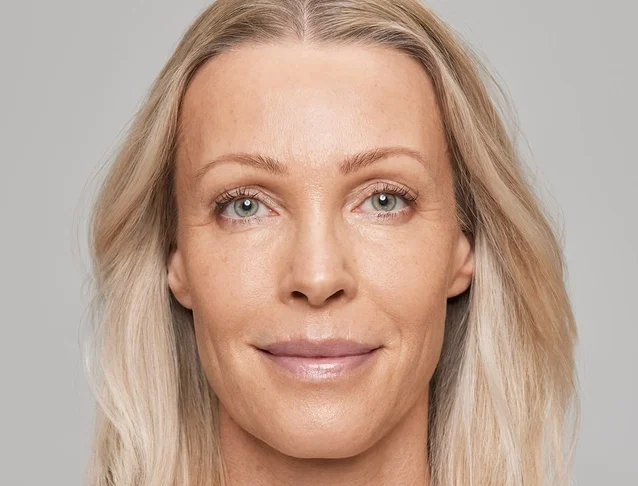 consumer_v3_restylane_temples_basmall_evalena_after