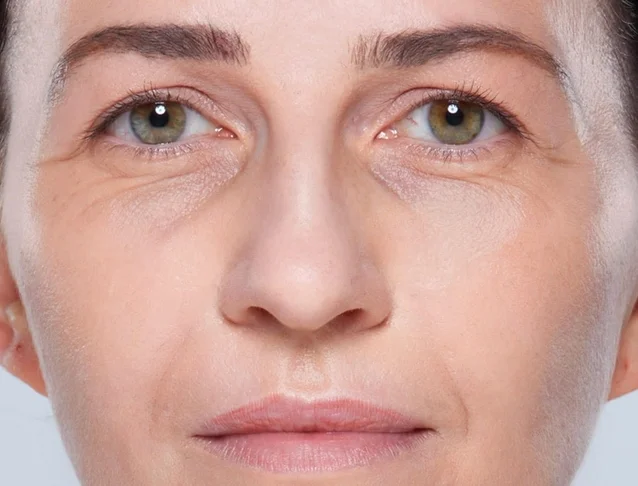 consumer_v3_restylane_undereyes