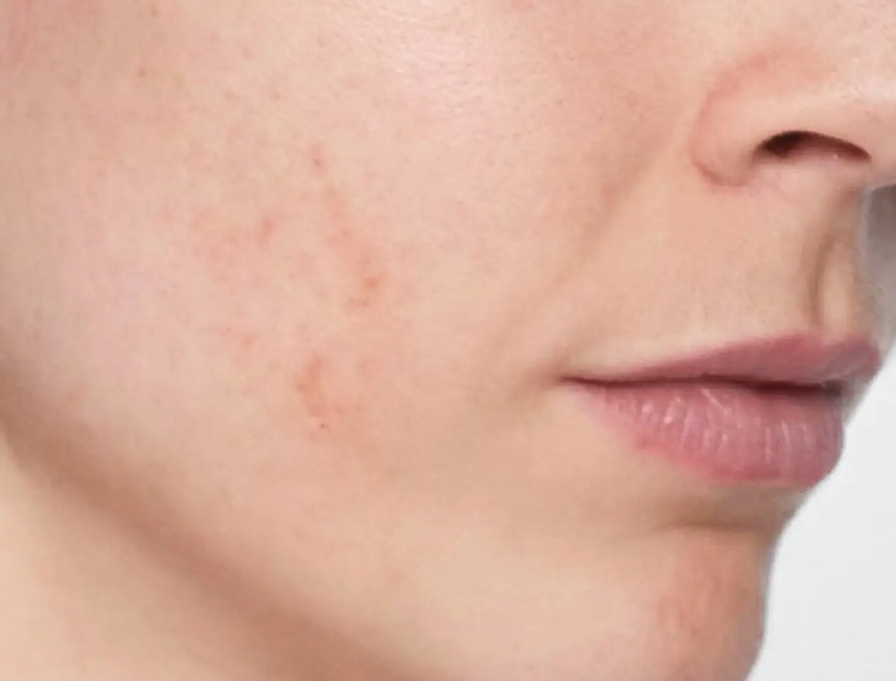 consumer_v3_skinboosters_face_basmall_carmela_before
