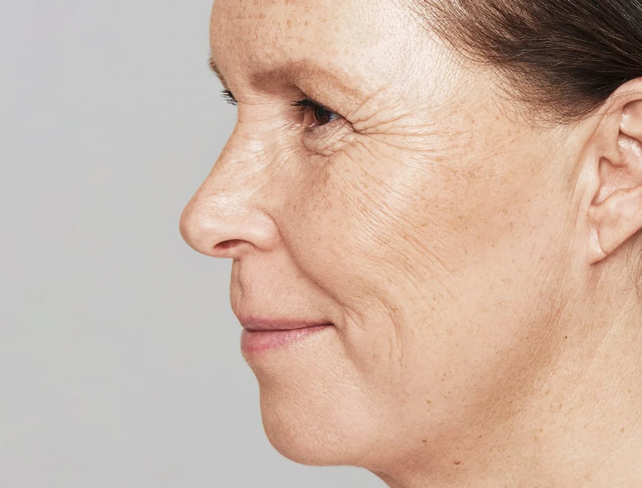 consumer_v3_skinboosters_face_basmall_katriina_after