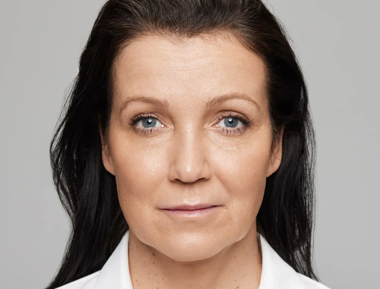 consumer_v3_skinboosters_face_basmall_mirjam_after