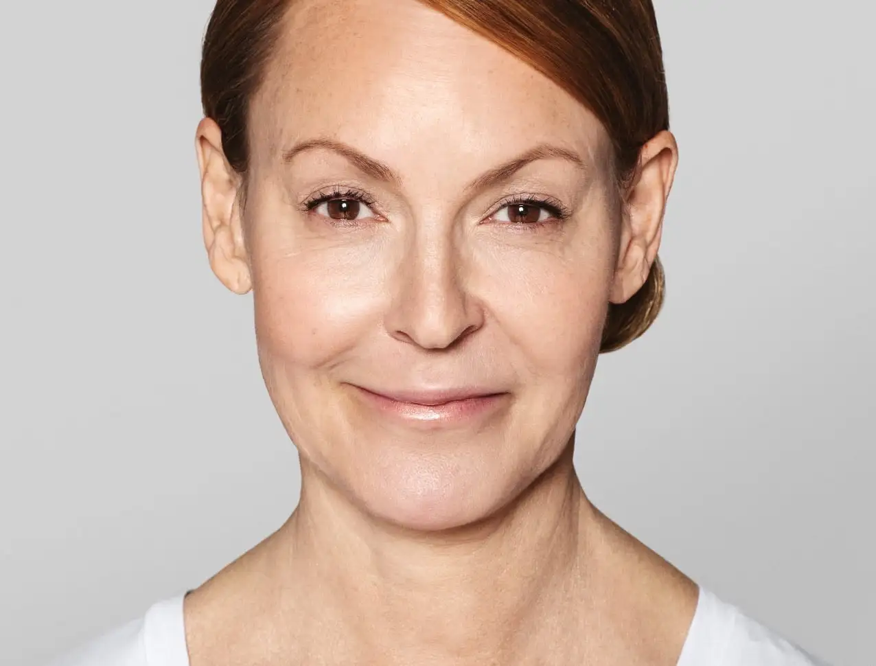 consumer_v3_skinboosters_neck_basmall_annika_after