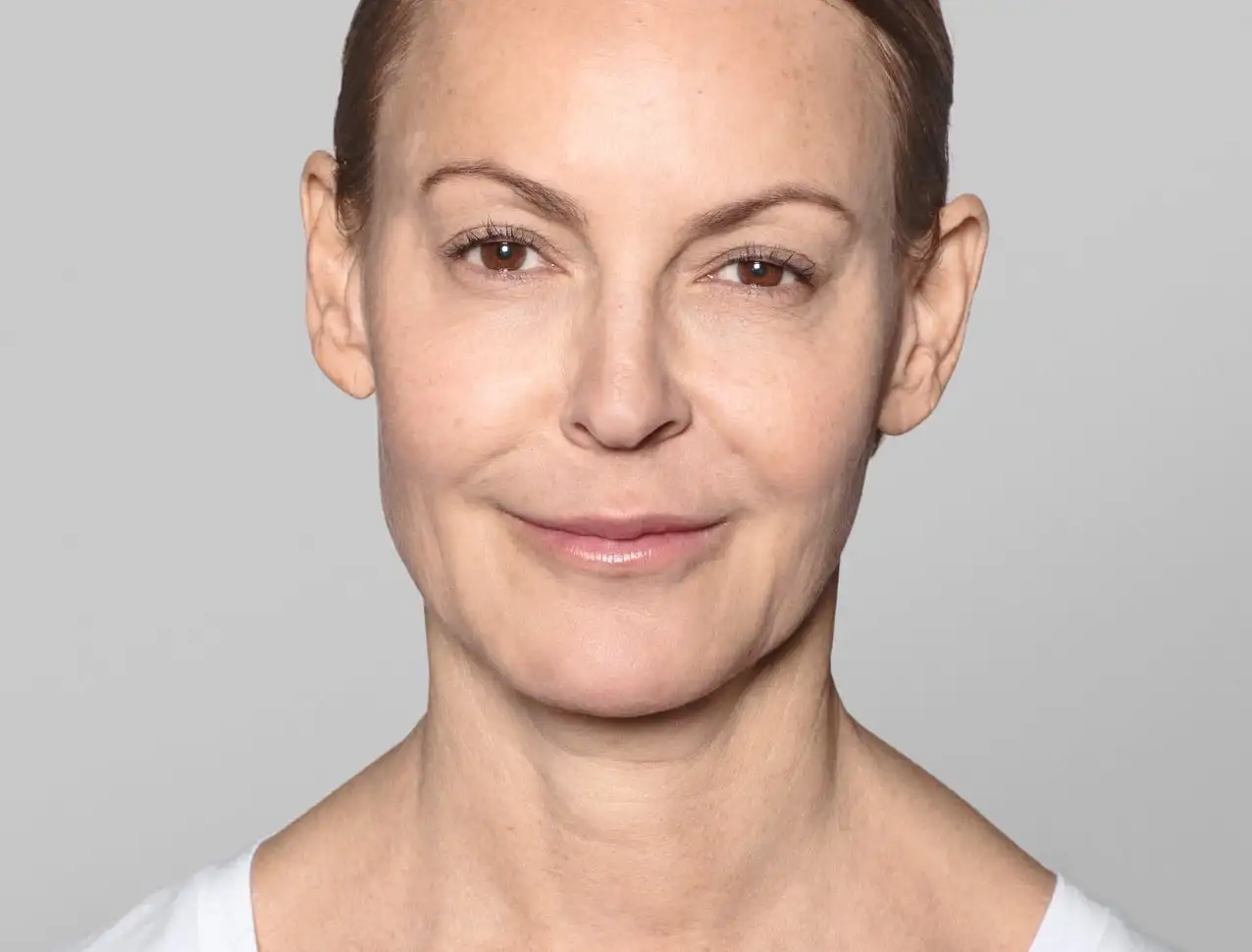 consumer_v3_skinboosters_neck_basmall_annika_before
