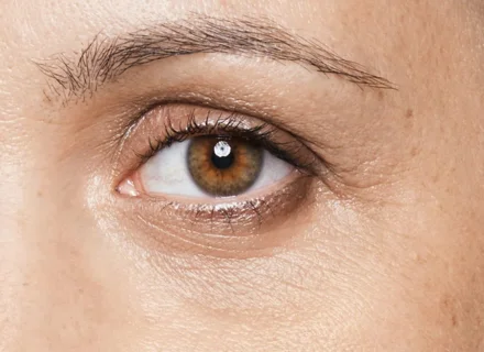 Dark circles under eyes
