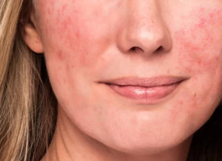 skin_redness