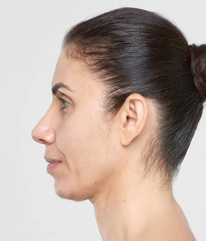sculptra_ba_ghenwa_after3months