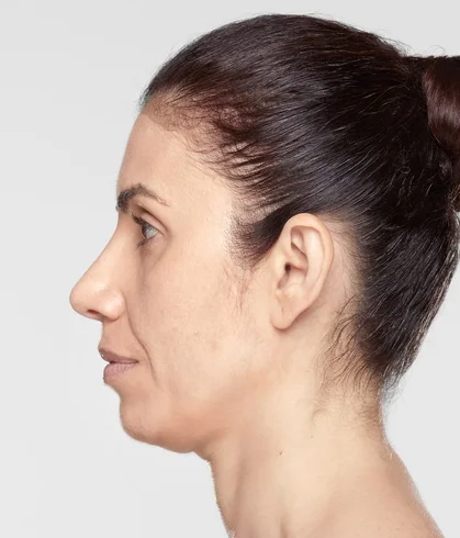 sculptra_ba_ghenwa_before