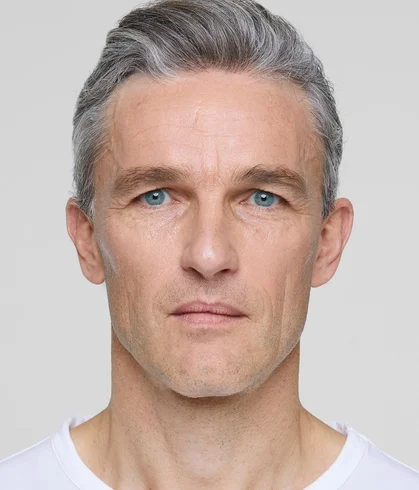 sculptra_ba_loic_after-3-months