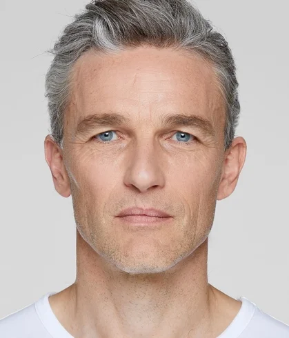 sculptra_ba_loic_before_1
