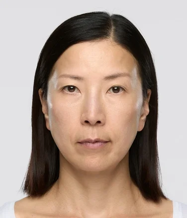 sculptra_ba_youni_after12months
