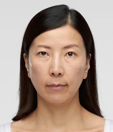 sculptra_ba_youni_after6months