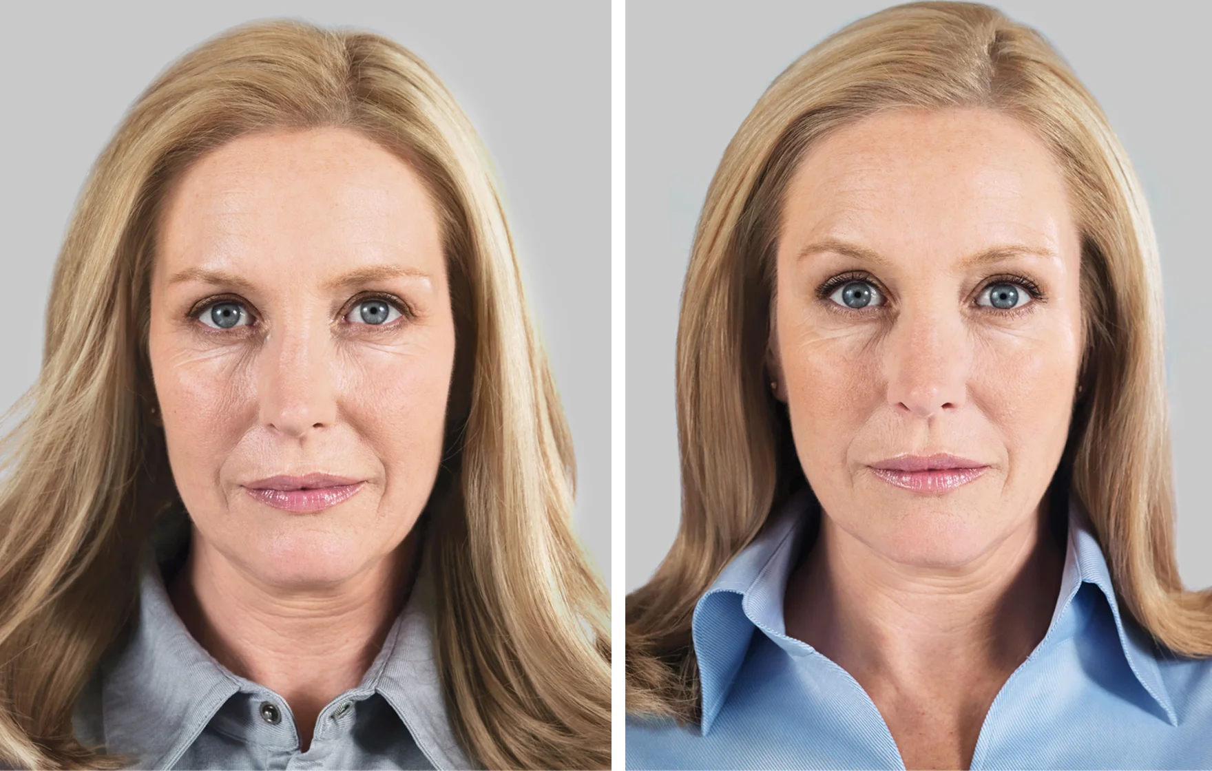 How to restore aged skin with a collagen biostimulator