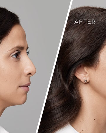 Chin fillers – all you need to know