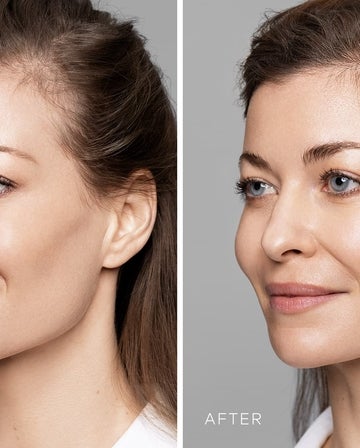 Will lips feel natural or not with HA lip fillers?