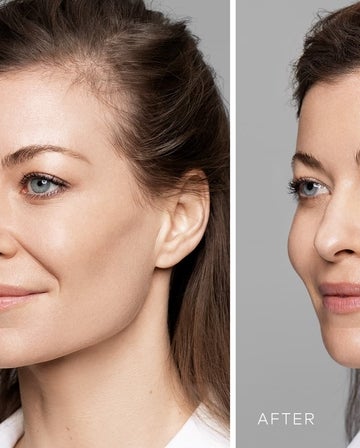 Will lips feel natural or not with HA lip fillers?