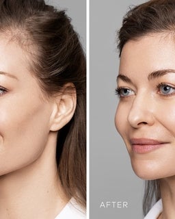 Will lips feel natural or not with HA lip fillers?