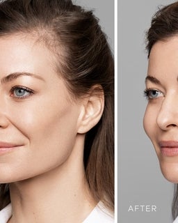 Will lips feel natural or not with HA lip fillers?