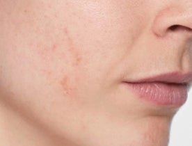 Skinboosters_CategoryPage_BannerLarge_Before