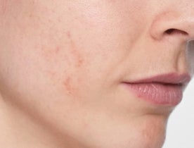 Consumer_V3_Skinboosters_Face_BAsmall_Carmela_Before