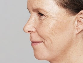 Consumer_V3_Skinboosters_Face_BAsmall_Katriina_After