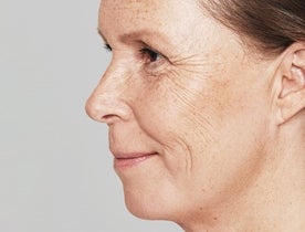 Consumer_V3_Skinboosters_Face_BAsmall_Katriina_Before