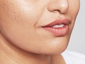 Consumer_V3_Skinboosters_Face_BAsmall_Rafat_Before