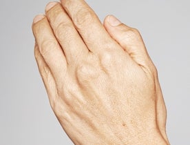 Consumer_V3_Skinboosters_Hands_BAsmall_Jenny_Before