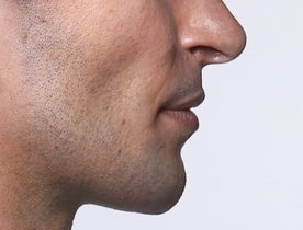 Restlayne After image