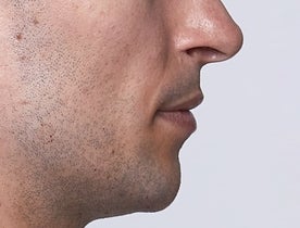 Restlayne Before image