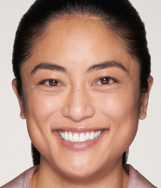 Other Aesthetic Treatments-before
