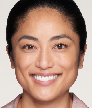 Other Aesthetic Treatments-after