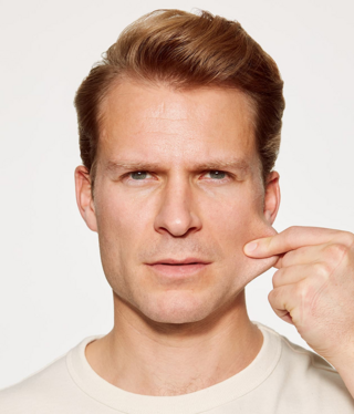 Sculptra® Regenerative biostimulator-after