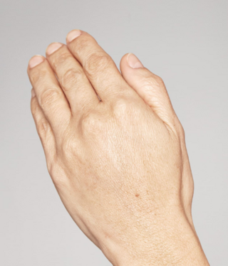 Restylane® SKINBOOSTERS™-after