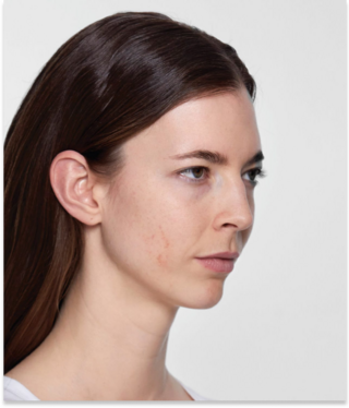 Restylane® SKINBOOSTERS™-before