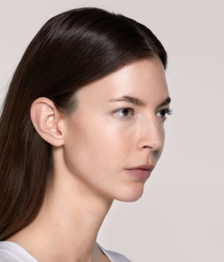 Restylane® SKINBOOSTERS™-after