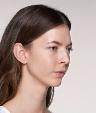 Restylane® SKINBOOSTERS™-after