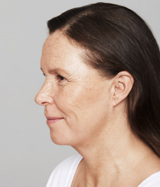 Restylane® SKINBOOSTERS™-after