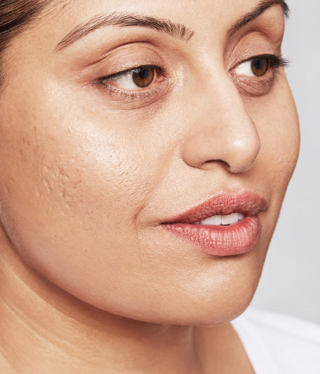 Restylane® SKINBOOSTERS™-before