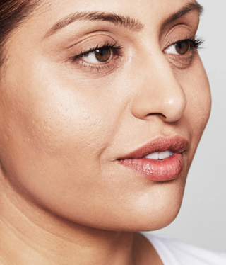 Restylane® SKINBOOSTERS™-after