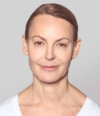 Restylane® SKINBOOSTERS™-before