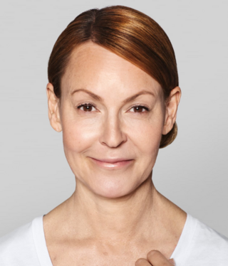 Restylane® SKINBOOSTERS™-after