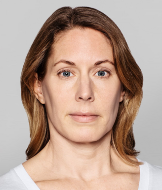 Restylane® SKINBOOSTERS™-before