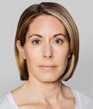 Restylane® SKINBOOSTERS™-after