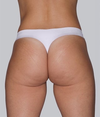 buttocks_aline_after6month