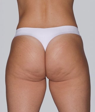 buttocks_aline_befor