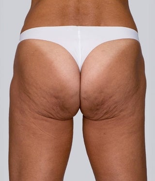 buttocks_valeria_before