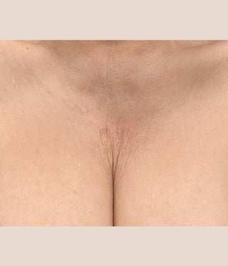 decolletage_before