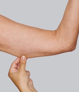 upperarms_suelly_after