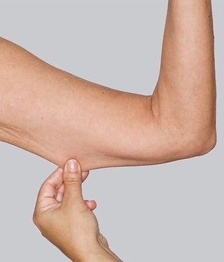 upperarms_suelly_before