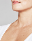 Restylane® SKINBOOSTERS™-before